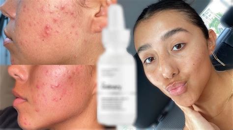 How To Brighten Acne Scars Archives Pimple Popping Videos