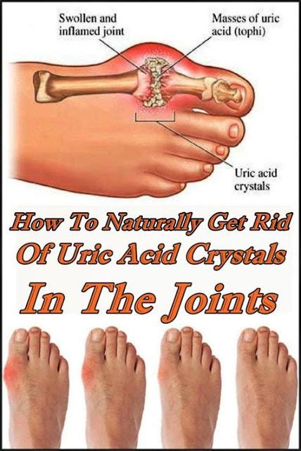 How To Naturally Get Rid Of Uric Acid Crystals In The Joints Remedy Day