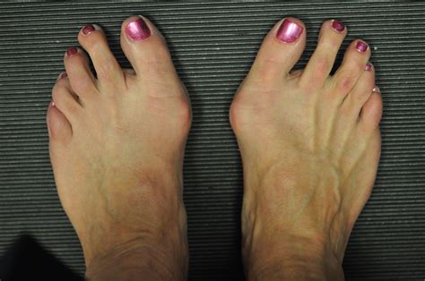 Bunions Orthoinfo Aaos