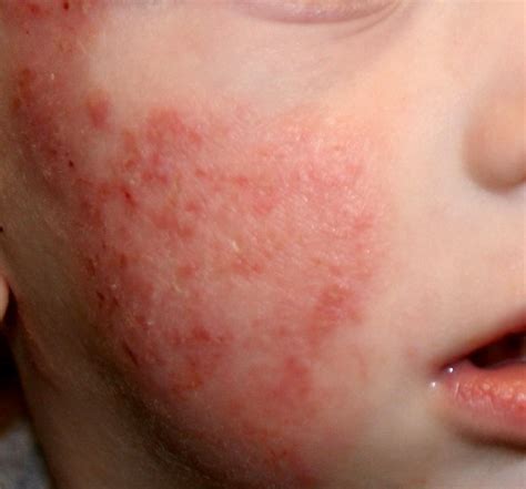 Dermatitis Atópica En Niños La Salud De Los Más Chicos Bebesaludnet