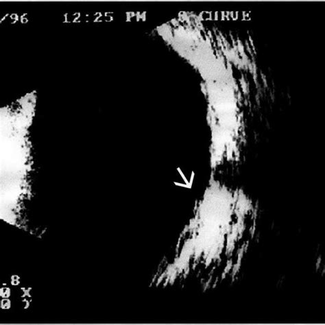 Ocular B Scan Echography Of Small Optic Disc Cupping By The Transcleral