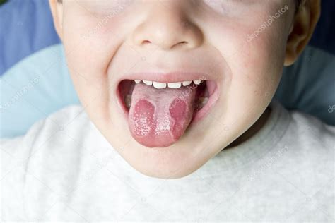 Geographic Tongue Disease In A Child — Stock Photo © Angelsimon 13904116