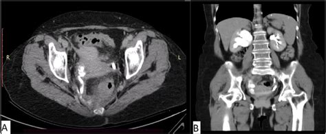 A Axial Pelvis Ct Scan Delayed Images At 20 Min Shows Abnormal