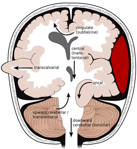 Brain Herniation Syndromes Wikem
