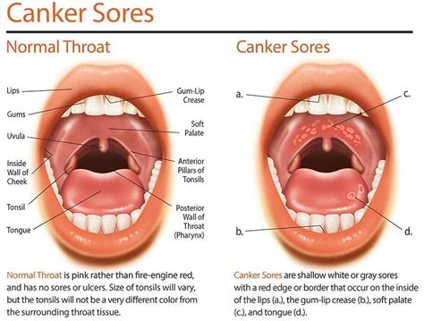 Common Causes Of Mouth Soreness