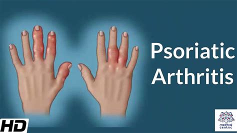 Psoriatic Arthritis Causes Signs And Symptoms Diagnosis And