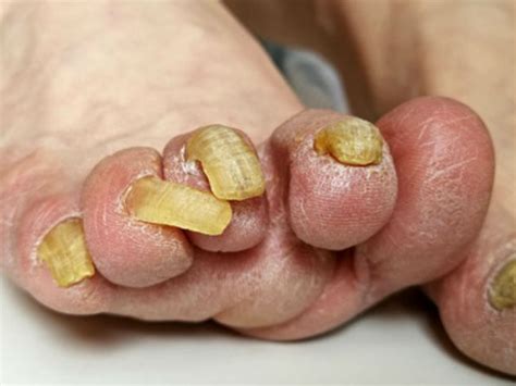 White Toenails Causes Prevention Cures