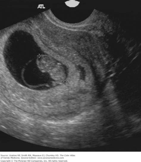 First Trimester Ultrasound Anatomy