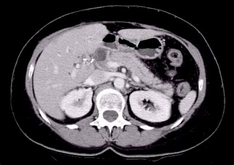 Pancreas Tumor Ct Scan Anatomybox