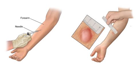 They put a needle under your skin and a bubble is there. Mantoux Test : Principle, Procedure, Interpretation and ...