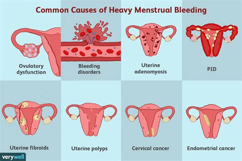 Menorrhagia Heavy Menstrual Bleeding Symptoms And More