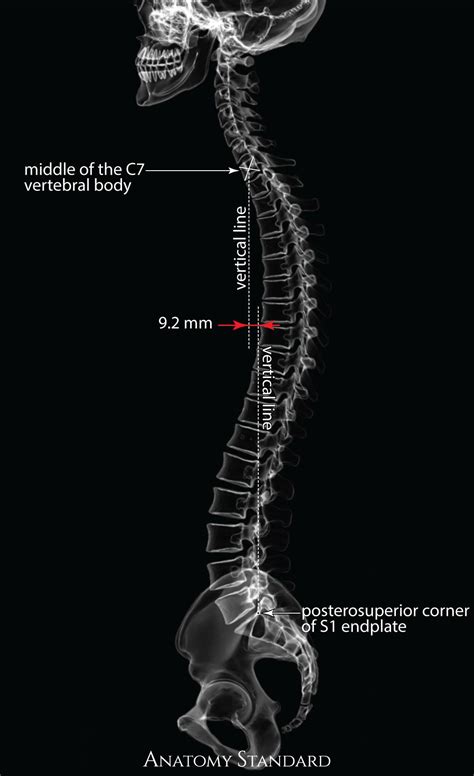 Pin On Sagittal Alignment Of The Spine