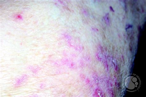 Leukemia cutis characteristically demonstrates the infiltration of the skin by neoplastic leukocytes. Leukemia Cutis - 2.