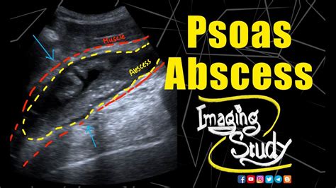 Psoas Muscle Abscess Ultrasound Case 231 Youtube