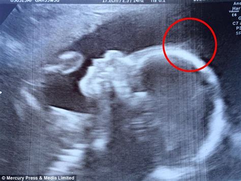 Baby Girl With So Much Hair It Showed Up On Her Ultrasound Daily Mail Online