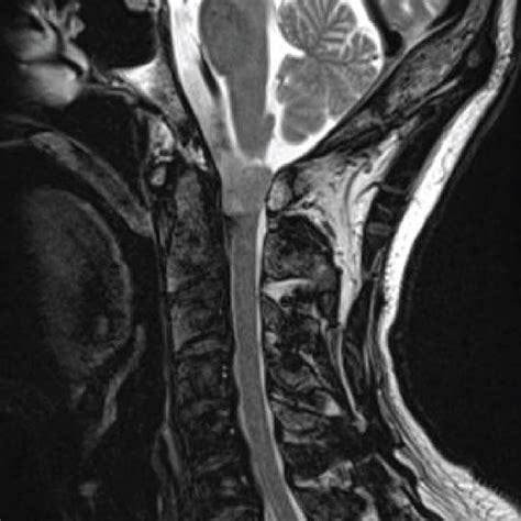 A T2 Weighted Sagittal Mri Of The Cervical Spine Showed A Tumor In