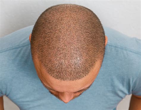 Understanding The Shock Shedding Process After Hair Transplant In 6
