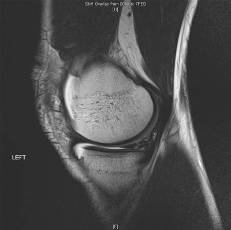 Meniscal Injury Knee Sports Orthobullets 2800 Hot Sex Picture