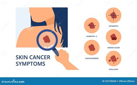 Skin Cancer Symptoms Stock Vector Illustration Of Melanin 223738658