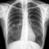 Röntgen-Thorax, a.p.: COPD, Melanom Metastase - DocCheck