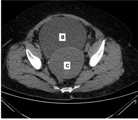 Ct Scan Of The Abdomen Reveals A Distended Urinary Bladder B And