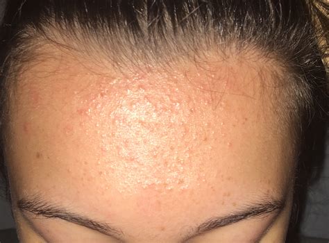 Forehead Bumps Acne Nothing Works General Acne Discussion
