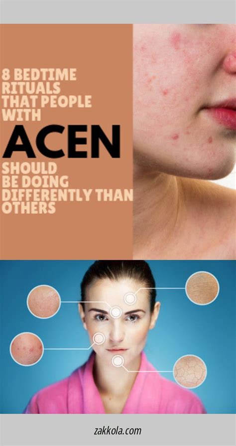 Can Allergies Cause Cystic Acne