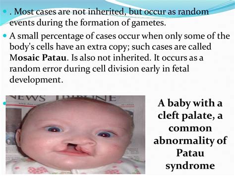 Patau Syndrome