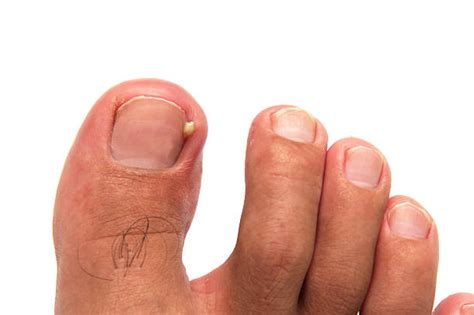 Ingrown Toenail Stock Photos Pictures And Royalty Free Images Istock