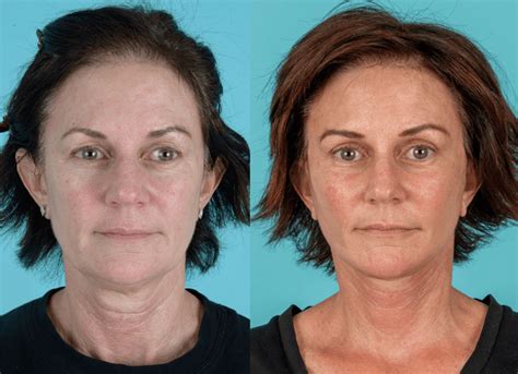 Coastal Facial Plastic Surgery And Aesthetics Reconstructive Plastic