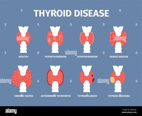 Thyroid Gland Various Diseases Goiter And Hyperthyroid Inflammation