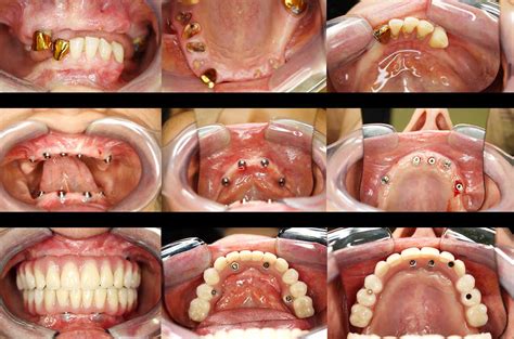 Dental Implants All On 4 Teeth In A Day™ Cosmo Dental