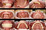 Dental Implant Steps Pictures Images