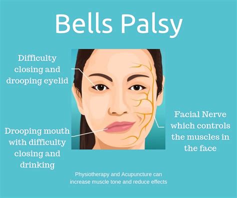 Facial Nerve Mobile Physiotherapy Clinic Ahmedabad Gujarat