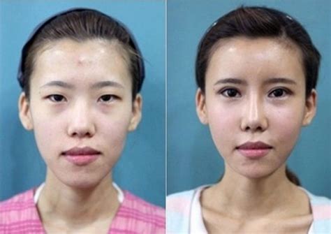 Crazy Before And After Photos Of South Korean Plastic Surgery Page 3