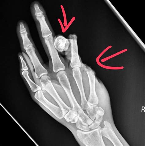 Hand Injuries Radiographer Xray Tech Emergency Medicine Sports Injury Medical Field