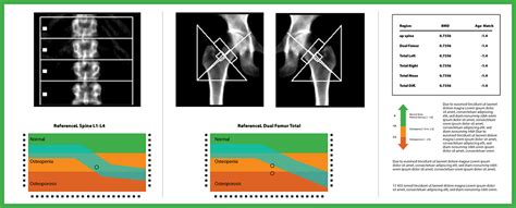 Diagnose osteopenia (low bone mass). DEXA Scan: Everything You Need (& Want) to Know