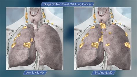 Survival Stage 3 Lung Cancer