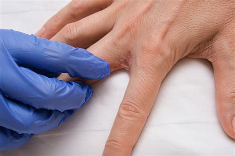 A Doctor Dermatologist Examines Patients Hand With Interdigital