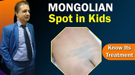 Mongolian Spot Treatment In Delhi Get Rid Of Mongolian Spots By Dr Pk