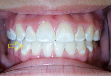 View White Lines On Teeth Near Gums Images Florisruwhof