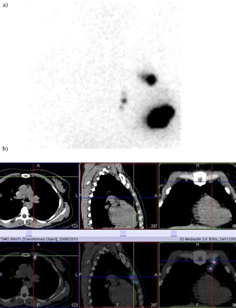 Lymphoscintigraphy Can Select Breast Cancer Patients For Internal