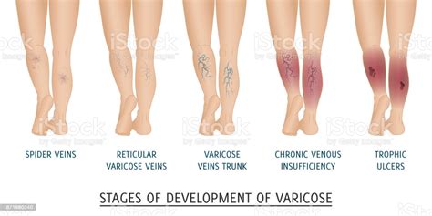 Types Of Varicose Veins In Women Stages Of Development Of Varic Stock