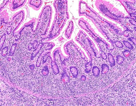Diffuse Large B Cell Lymphoma Photograph By Webpathologyscience Photo