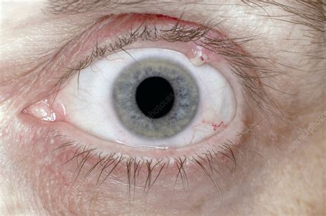 Stye Bacterial Eye Infection Stock Image C0091226 Science Photo