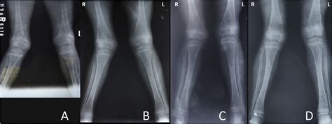 Case Report Children With Severe Nutritional Rickets In The Naga
