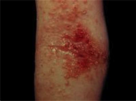 Derm Eczematous Eruptions With Photos Flashcards Quizlet