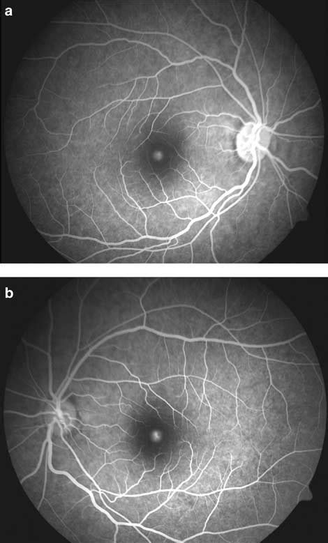 A Fundus Fluorescein Angiogram Late Venous Phase Of The Right Eye