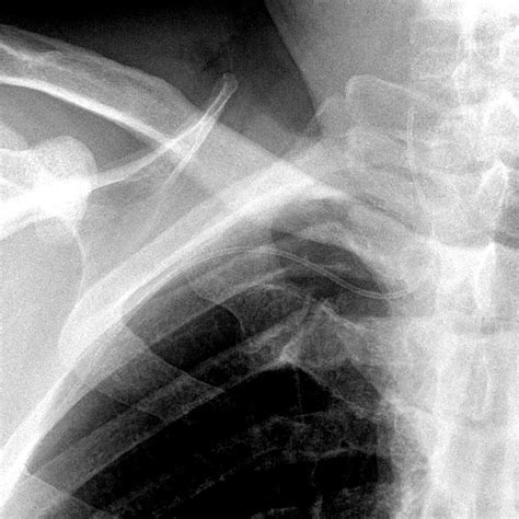 Picc Line Malposition Image