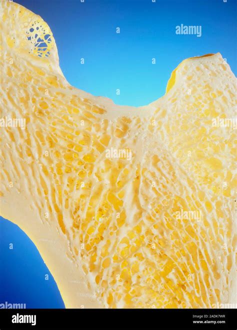 Thigh Bone Normal Human Cancellous Spongy Bone From The Femur Thigh